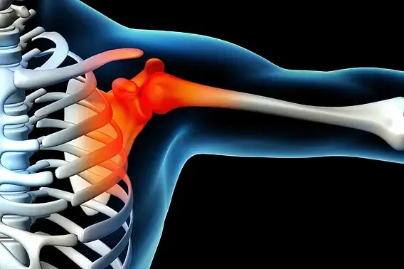 Ilustração do ombro humano com capsulite adesiva, destacando a inflamação tratada pelo Dr. Pedro Henrique Lopes.