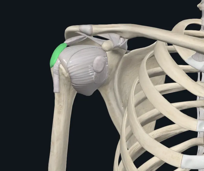Ilustração anatômica mostrando o ombro com destaque para a bursite.