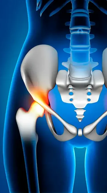 Visão frontal das articulações do quadril com lesões labrais destacadas em laranja, tratadas pelo Dr. Pedro Henrique Lopes.