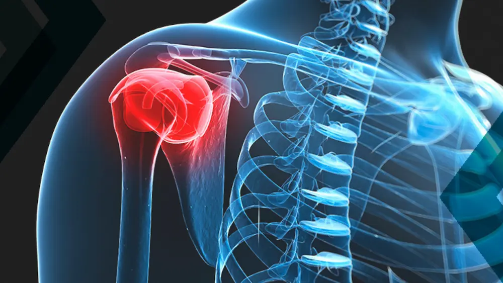 Representação em raio-x do ombro com capsulite adesiva, uma condição tratada pelo Dr. Pedro Henrique Lopes.