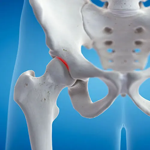 Close na articulação do quadril destacando lesões labrais, tratadas pelo Dr. Pedro Henrique Lopes.