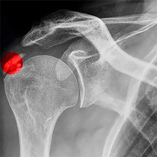 Raio-x do ombro destacando a área calcificada típica da tendinite calcária, tratada pelo Dr. Pedro Henrique Lopes.