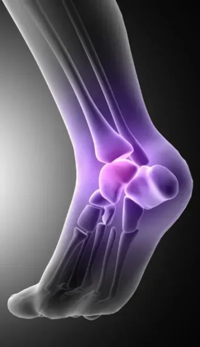 Representação em 3D de um pé com destaque na fascite plantar, tratada pelo Dr. Pedro Henrique Lopes.